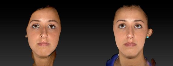 Rhinoplasty before and after pictures in East Lansing, MI, Patient 281