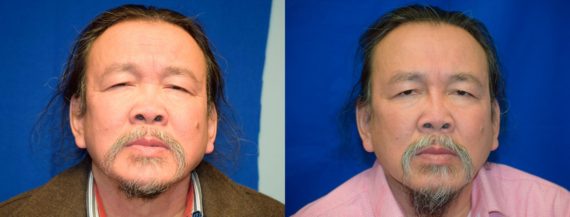 Rhinoplasty before and after pictures in East Lansing, MI, Patient 287