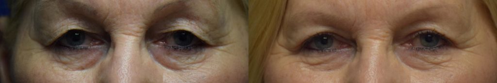 Blepharoplasty Before & After Photos | Ahmed Sufyan, MD