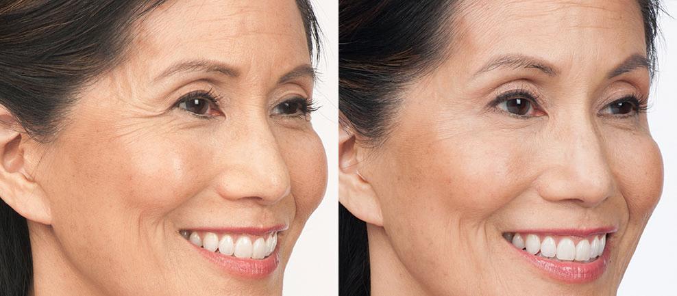 Botox Fillers Before & After Photos | Ahmed Sufyan, MD
