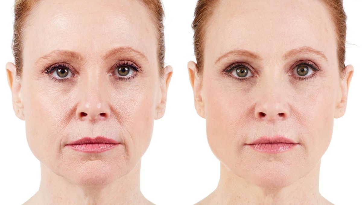 Botox Fillers Before & After Photos | Ahmed Sufyan, MD