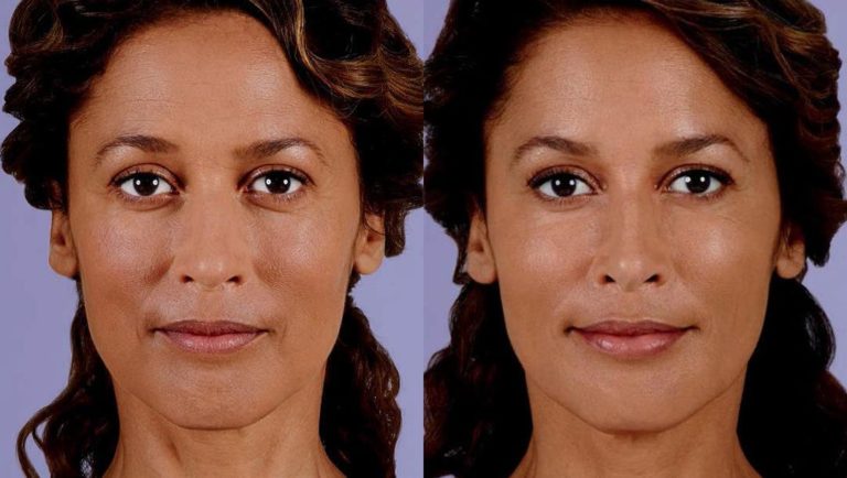 Botox & Fillers in Michigan | East Lansing Plastic Surgery
