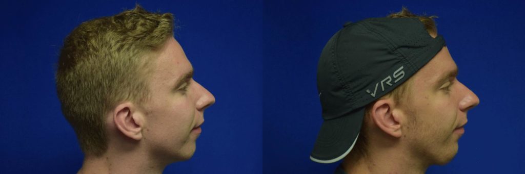 Chin Implant Before & After Photos | Ahmed Sufyan, MD