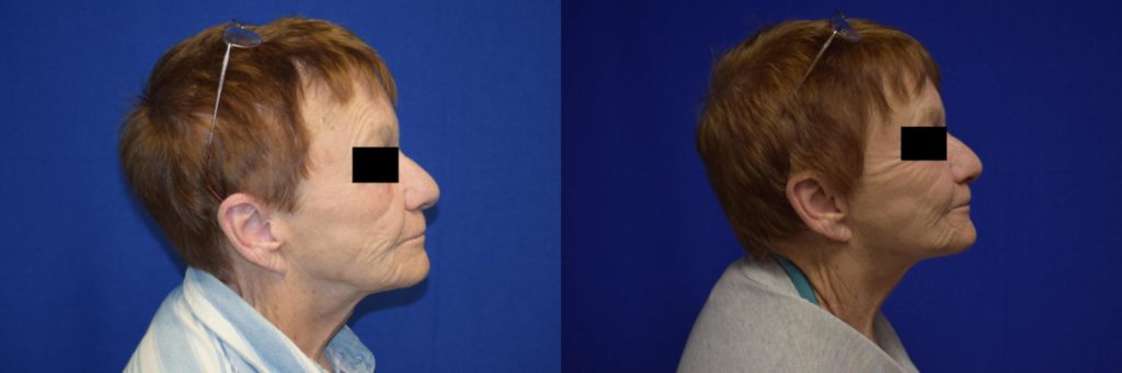Neck Lift Before & After Photos | Ahmed Sufyan, MD