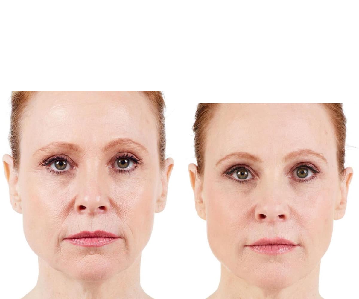 Botox & Fillers in Michigan East Lansing Plastic Surgery