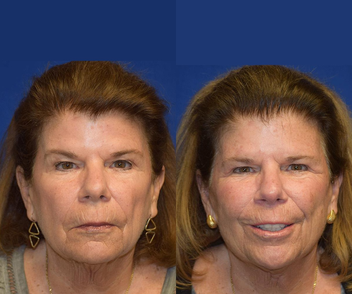 Lower Lip Augmentation | Dr. Kolstad - San Diego Facial Plastic Surgeon