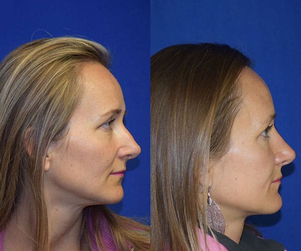 Rhinoplasty Before & After Photos | Ahmed Sufyan, MD