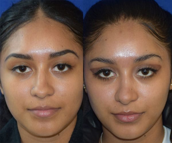 Rhinoplasty Before & After Photos | Ahmed Sufyan, MD